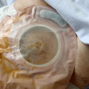 İleostomi Torbası Ücreti SGK'dan Çıkarıldı Emekli Hastalar Mağdur