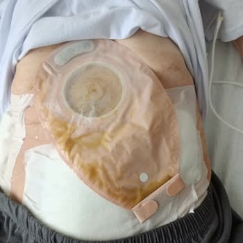 İleostomi Torbası Ücreti SGK'dan Çıkarıldı Emekli Hastalar Mağdur