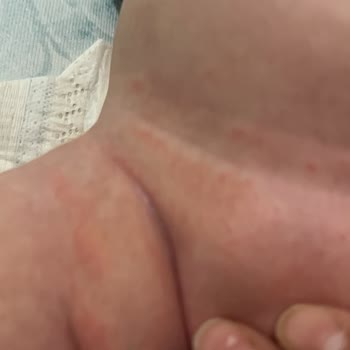Migros’ta Satın Alınan Sleepy Bebek Bezinde Alerji Ve Kabarma Sorunu