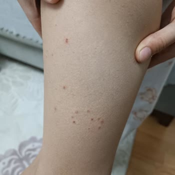 Çocuk Yataklarındaki Yara Bırakan Sağlık Riski Ve Aşırı Fiyat Şikayeti