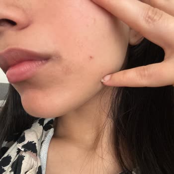 Flormar Lip Plumper Caused Severe Burning and Skin Irritation