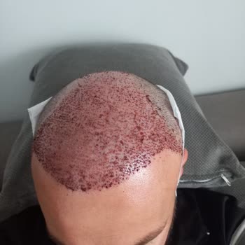 Art Hair Clinic Saç Ekimi Sonrası Hayal Kırıklığı Ve Ücret İadesi Talebi