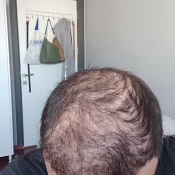 Art Hair Clinic Saç Ekimi Sonrası Hayal Kırıklığı Ve Ücret İadesi Talebi