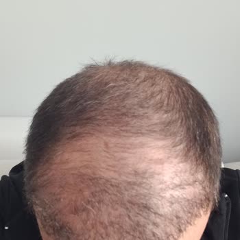 Art Hair Clinic Saç Ekimi Sonrası Hayal Kırıklığı Ve Ücret İadesi Talebi