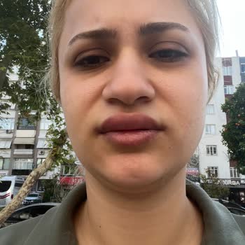 Herbalife Ürünlerinden Alerjik Reaksiyon Sonrası 19 Bin TL İade Talebi