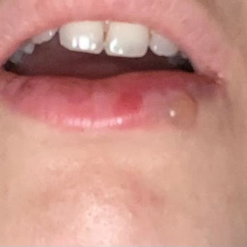 Ağır Nörolojik Komplikasyon Ve Yetersiz Bilgilendirme Nedeniyle Sıvı Beslenmeye Zorlanan Hasta