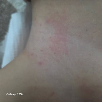 Sızdırma Ve Şiddetli Pişik Sorunu