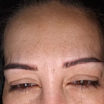 Derma Team Güzellik | Adana Botoks Hiçbir Şekilde Tutmadı