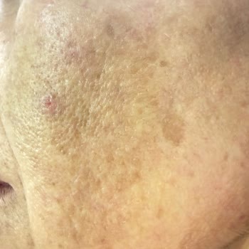 Retinol İçeren Sabah Kremi Uyarısının Eksikliği Cilt Hasarına Yol Açtı