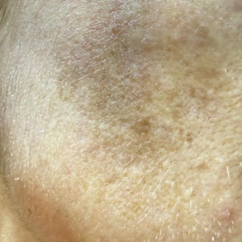 Retinol İçeren Sabah Kremi Uyarısının Eksikliği Cilt Hasarına Yol Açtı