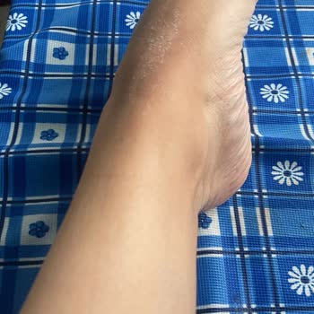 Sağlık Sorunlarına Yol Açan IPL Cihazı İçin Geri Ödeme Ve Satıcı İncelemesi Talebi