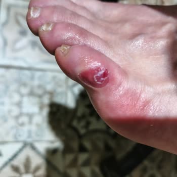 Reebok Royal Glide Kadın Sneaker’da Ayak Parmağında Şiddetli Ağrı Ve Nasır