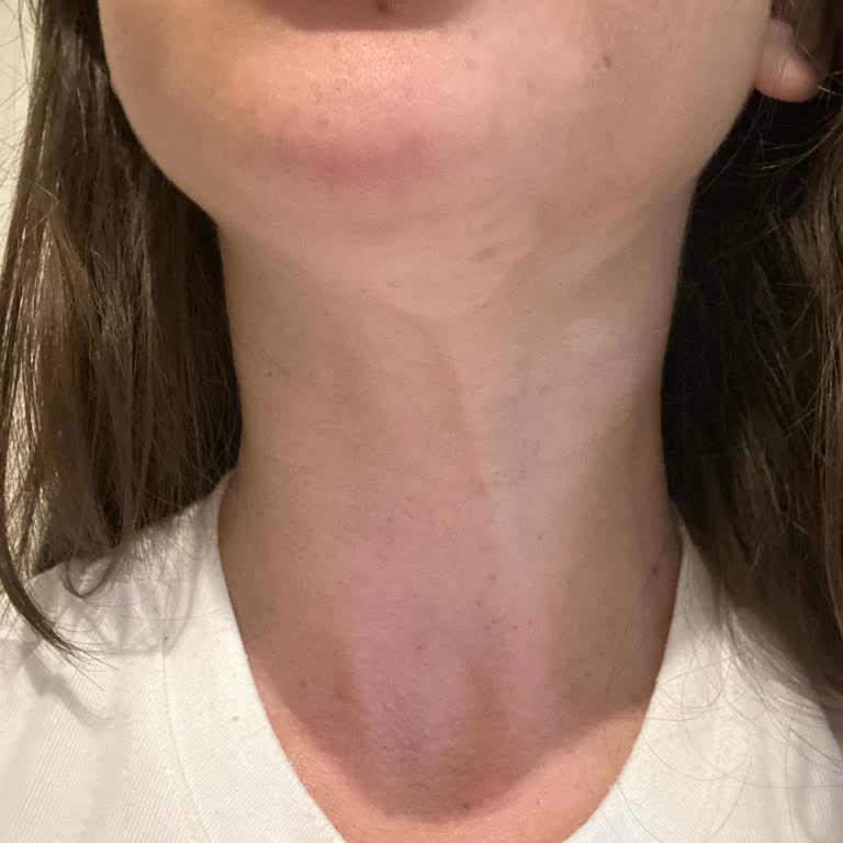 Yanlış Tanı Ve Bilgilendirme Eksikliği Nedeniyle Vitiligo Sorunumun Kötüleşmesi