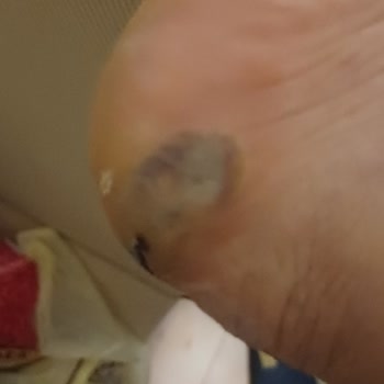 Ayakkabı Tabanı Esnemediği İçin Sağlık Problemi Ve Yanıltıcı Deri İddiası
