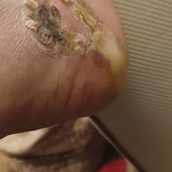 Ayakkabı Tabanı Esnemediği İçin Sağlık Problemi Ve Yanıltıcı Deri İddiası