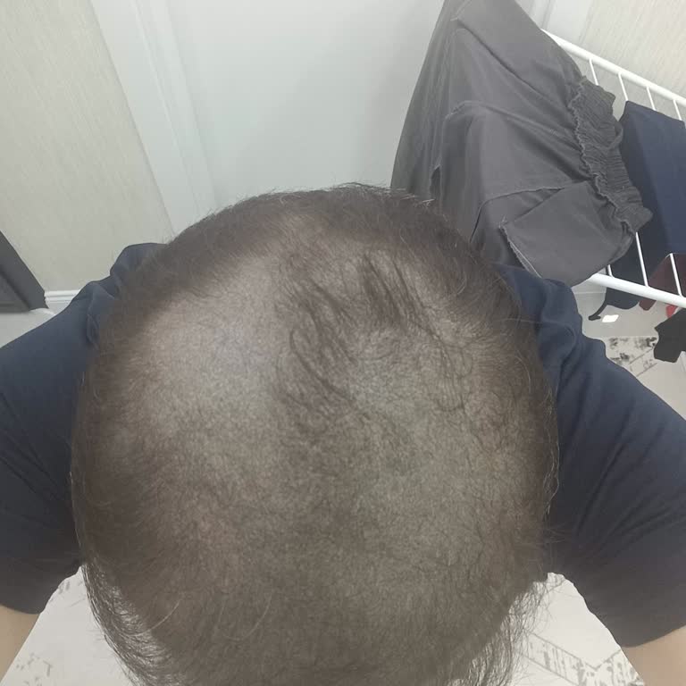 Saç Simülasyonu 15 Yıl Kalıcılık Vaadi Boşa Çıktı Ve Renk Değişimi Sorunu