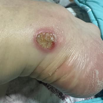 Skechers Ayakkabısının Topuk Yarası Nedeniyle Değişim İsteği