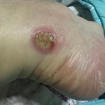 Skechers Ayakkabısının Topuk Yarası Nedeniyle Değişim İsteği