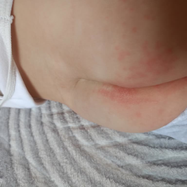 Sleepy Bebek Bezinde Ciddi Döküntü Ve Yanık: Sağlık Sorunu Ve Mağduriyet
