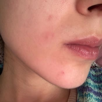 Yeni Formül Jeuvenile Kremi Ciltte Olumsuz Etki Yaratıyor, Ayıplı Ürün Talebi