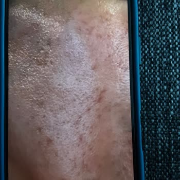 Söz Verilen Leke Tedavisi Gelmedi, Cilt Yanıkları Bıraktı