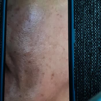 Söz Verilen Leke Tedavisi Gelmedi, Cilt Yanıkları Bıraktı