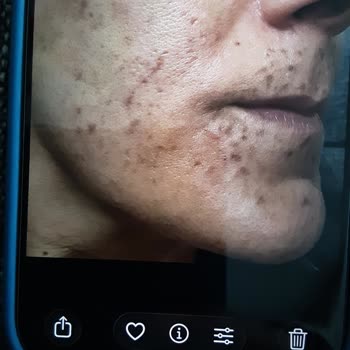Söz Verilen Leke Tedavisi Gelmedi, Cilt Yanıkları Bıraktı