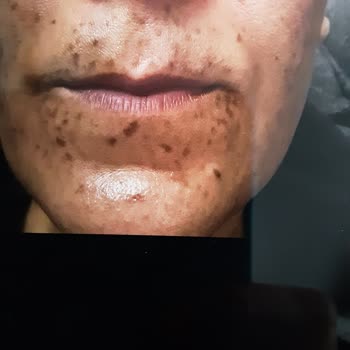 Söz Verilen Leke Tedavisi Gelmedi, Cilt Yanıkları Bıraktı