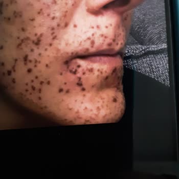 Söz Verilen Leke Tedavisi Gelmedi, Cilt Yanıkları Bıraktı