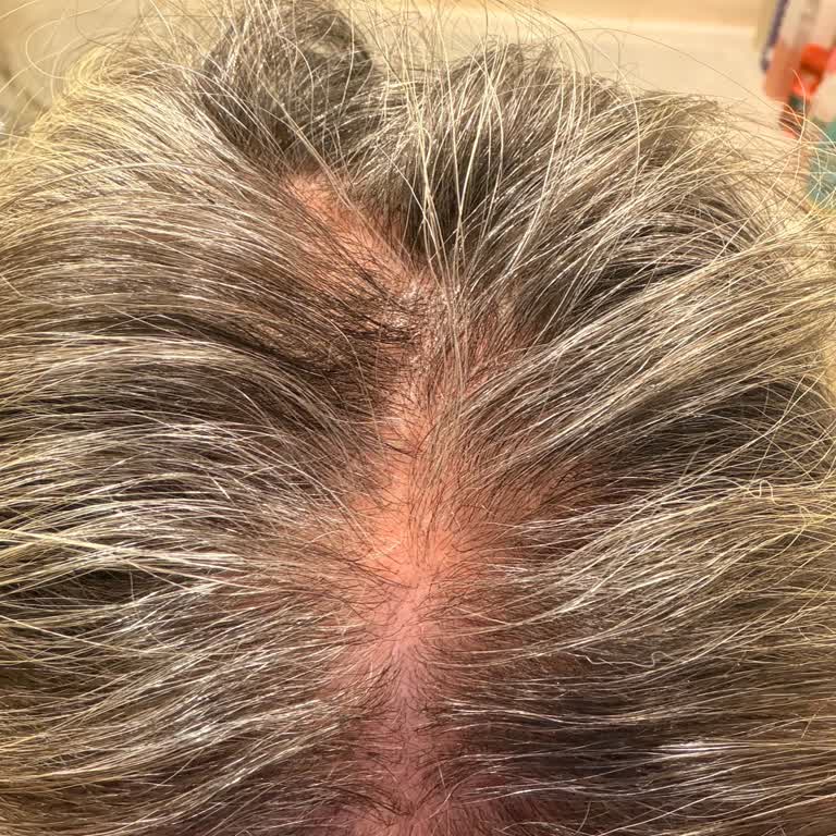 Berches Hair İşlemden Bu Yana İki Gündür Bu Sorunları Yaşıyorum