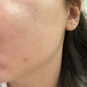 Yves Rocher Sebo Active Clear Yüz Kremi Cildimde Şiddetli Yağlanma Ve Sivilcelere Yol Açtı