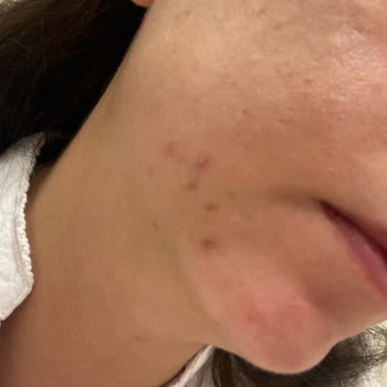 Yves Rocher Sebo Active Clear Yüz Kremi Cildimde Şiddetli Yağlanma Ve Sivilcelere Yol Açtı