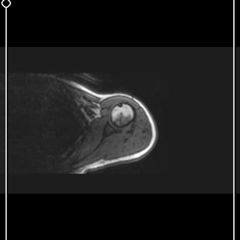 Ortopedi Doktoru MR Sonuçlarını Görmedi Ve Bilgilendirme Yapmadı