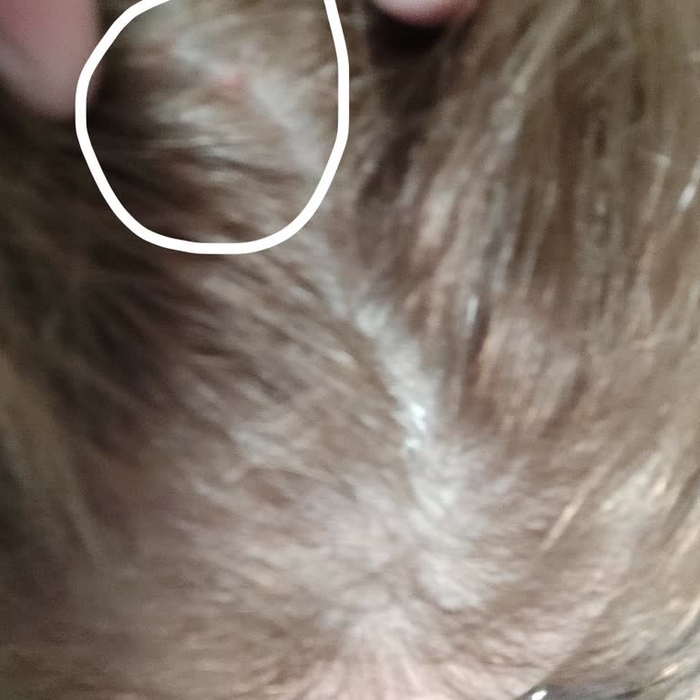 Schwarzkopf Palette Boyasında Şiddetli Yanma Ve Yara Oluşumu
