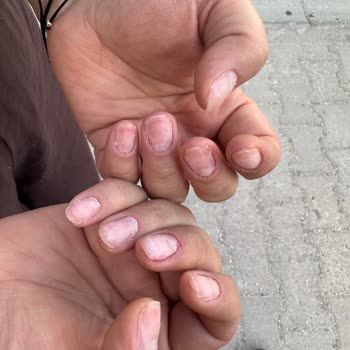 Özensiz Tırnak Bakımı Sonrası Yaralanma Ve Çıkartma Ücreti Talebi