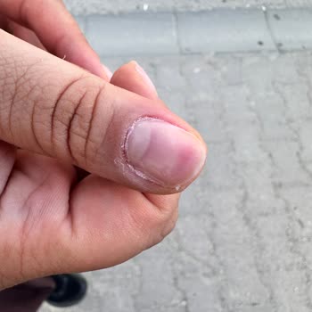 Özensiz Tırnak Bakımı Sonrası Yaralanma Ve Çıkartma Ücreti Talebi
