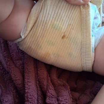 Bebek Bezlerinde Delik Ve Yırtıklar Cilt Tahrişi Ve Sızdırma Yarattı