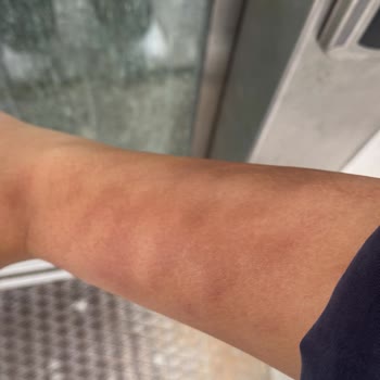 Arix Güzellik Salonu Cilt Kontrolü Yapılmadan Yüksek Dereceli Yanık