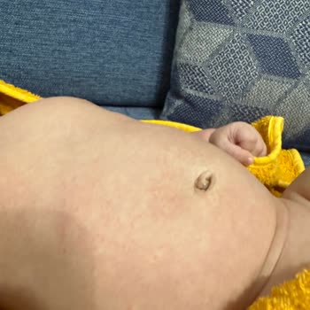 Mustela Yenidoğan Şampuanı Kullanımından Sonra Bebekte Kızarıklık Ve Değişim Talebi