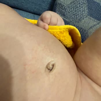 Mustela Yenidoğan Şampuanı Kullanımından Sonra Bebekte Kızarıklık Ve Değişim Talebi