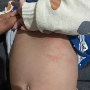 Bebekte Alerji Yaratan Mustela Ürünleri İçin Tam İade Talebi