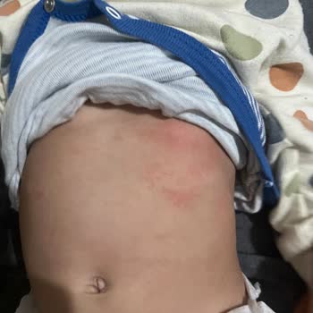 Bebekte Alerji Yaratan Mustela Ürünleri İçin Tam İade Talebi