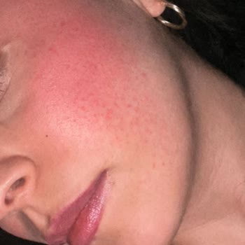 Nyx Allıktan Cilt Reaksiyonu Ve İade Talebi