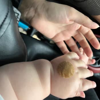Yanlış Açılan Damar Yolu Yeni Doğan Bebeğin Kolunda Şişlik Ve Morarma Oluşturdu