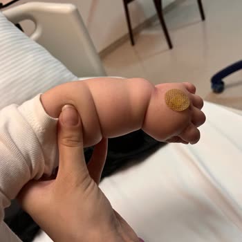 Yanlış Açılan Damar Yolu Yeni Doğan Bebeğin Kolunda Şişlik Ve Morarma Oluşturdu
