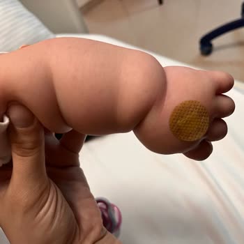 Yanlış Açılan Damar Yolu Yeni Doğan Bebeğin Kolunda Şişlik Ve Morarma Oluşturdu