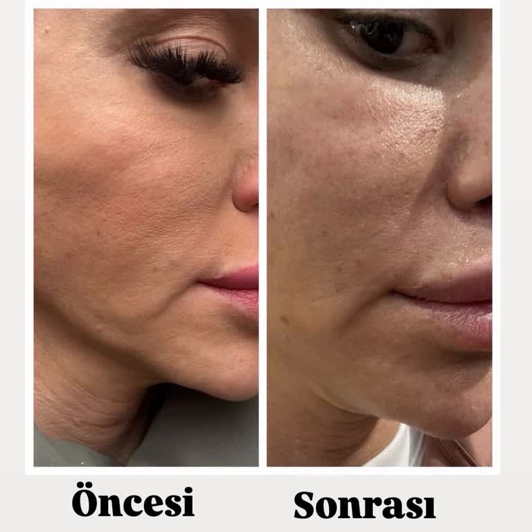 Op. Dr. Yücel Sarıaltın Yüz Germe Ameliyatı Sonrası Ağız Kenarı Bölgesinde Hiç İyileşme Olmadı