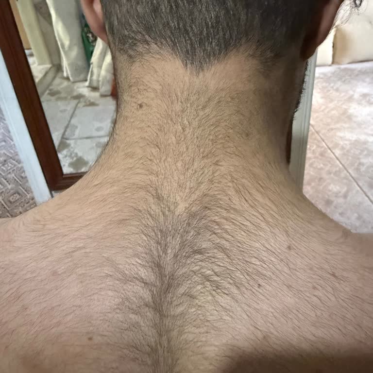 Rila Klinik Silopi Şubesinde Lazer Epilasyon Sonrası Kıl Artışı Ve Tehdit Şantaj İddiaları