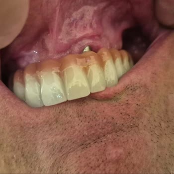 Yanlış Implant Ve Zirkonyum Tedavisi Sonrası Şiddetli Bozukluk Ve Görmezden Gelinme