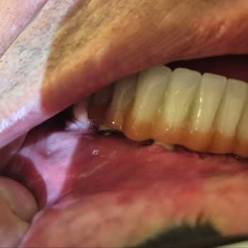 Yanlış Implant Ve Zirkonyum Tedavisi Sonrası Şiddetli Bozukluk Ve Görmezden Gelinme